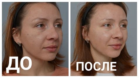 МОИ ПРОЦЕДУРЫ ДО и ПОСЛЕ ♥ косметология в Корее - YouTube