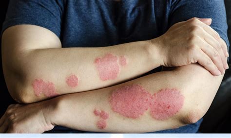Contact Dermatitis: Identifying Triggers For Your Skin Rash And Redness