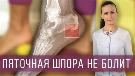Боль в пятке: пяточная шпора, плантарный фасциит. Причины, симптомы ...