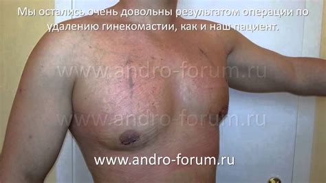Гинекомастия - YouTube
