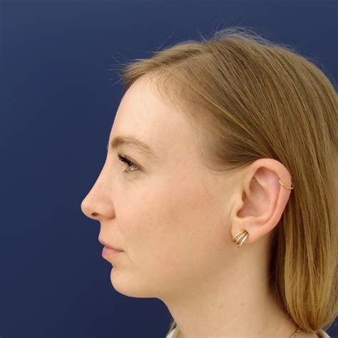 Galerie proměn - Rhinoplastika | Klinika Esthé Praha