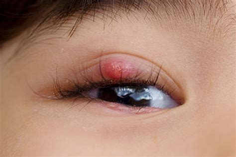 Stye Inside Eyelid