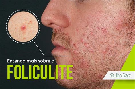 Qual Gilete Nao Da Foliculite - Entenda mais sobre a Foliculite - Bulbo Raiz