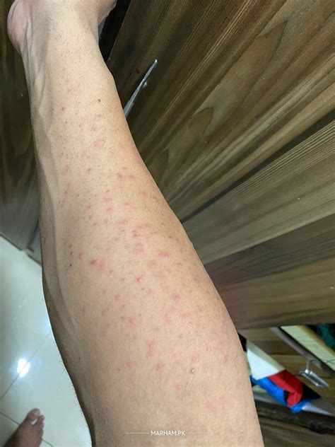 Ask a Dermatologist Online for Skin Allergy - Dermatitis