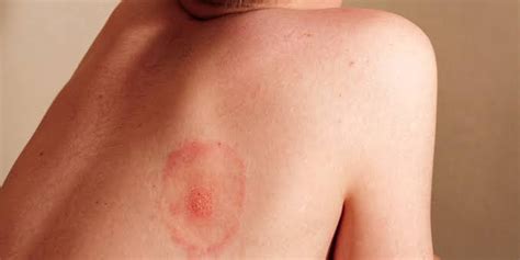 Myiasis: Symptoms, Causes, Treatment | Onlymyhealth