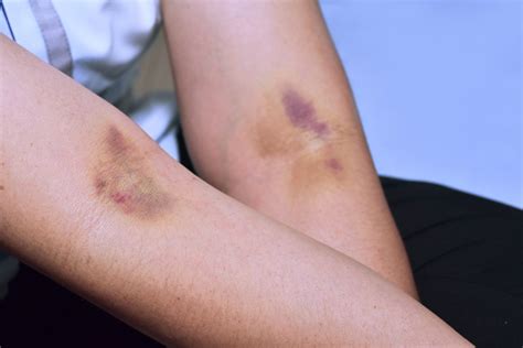 med journal  physical exam ultrasound needed  monitor recovery