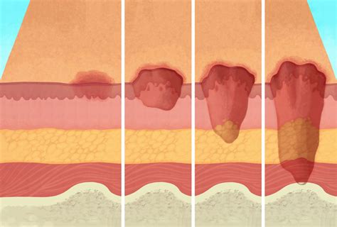 Ulcer Skin Descriptions