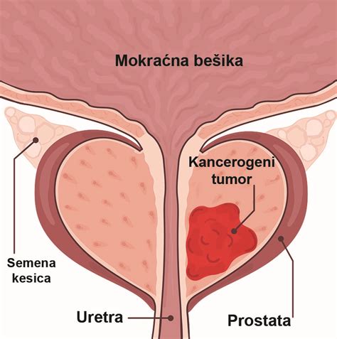 Oboljenja prostate-simptomi, dijagnoza i laboratorijski testovi - Beo ...