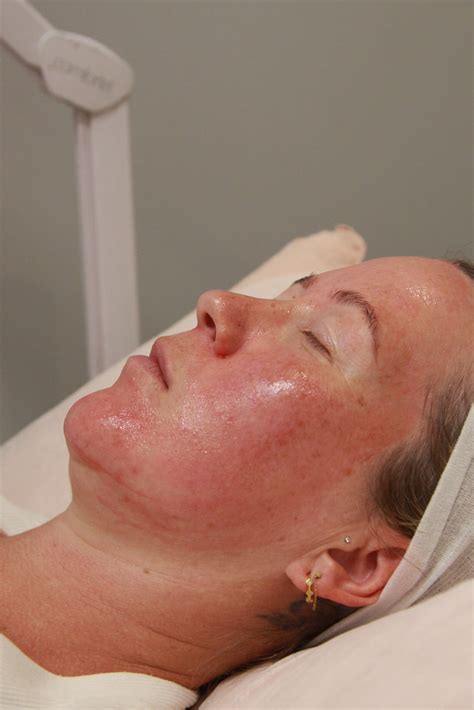 Pregnancy Safe Skin Treatments | Flawless Rejuvenation