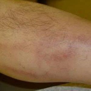 Флебит: симптомы и лечение флебита нижних и верхних конечностей