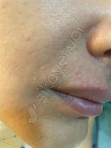 La Roche – Posay Severe Allergic Reaction to La Roche-Posay Hyalu B5