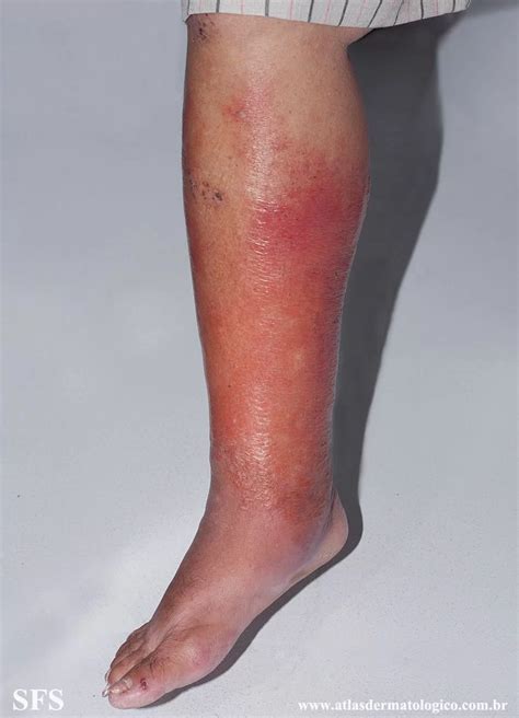 Infecção Na Pele Por Bactéria - Infecção Bacteriana De Pele - NAZAEDU