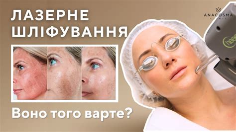 ЛАЗЕРНЕ ШЛІФУВАННЯ ОБЛИЧЧЯ — КОМУ І ДЛЯ ЧОГО? - YouTube