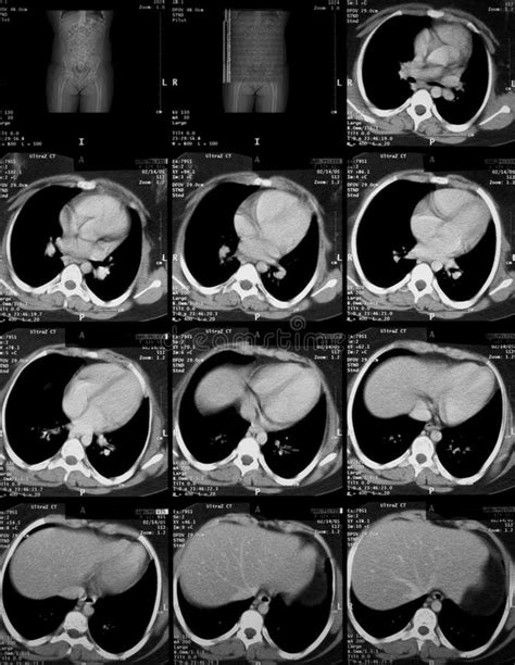 Ct-Scan von Abdomen stockfoto. Bild von inneres, gesundheit - 15528744
