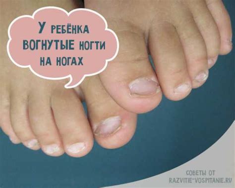 У ребенка слоятся ногти на ногах и на руках: советы комаровского