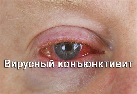 Вирусный конъюнктивит: симптомы и лечение