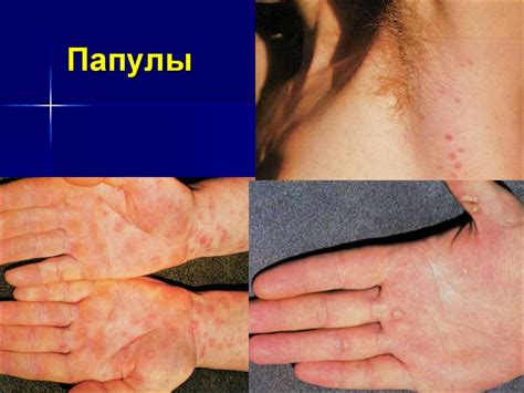 Сифилис. Этиология. Патогенез. Классификация. Клинические проявления ...