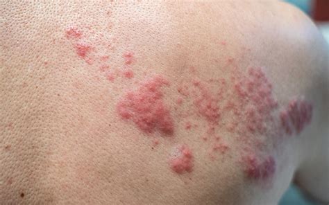 Viral Skin Infections