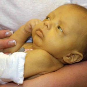 O Que É Amarelão Em Bebe - Icterícia neonatal: quando se preocupar com o amarelão? - Noeh