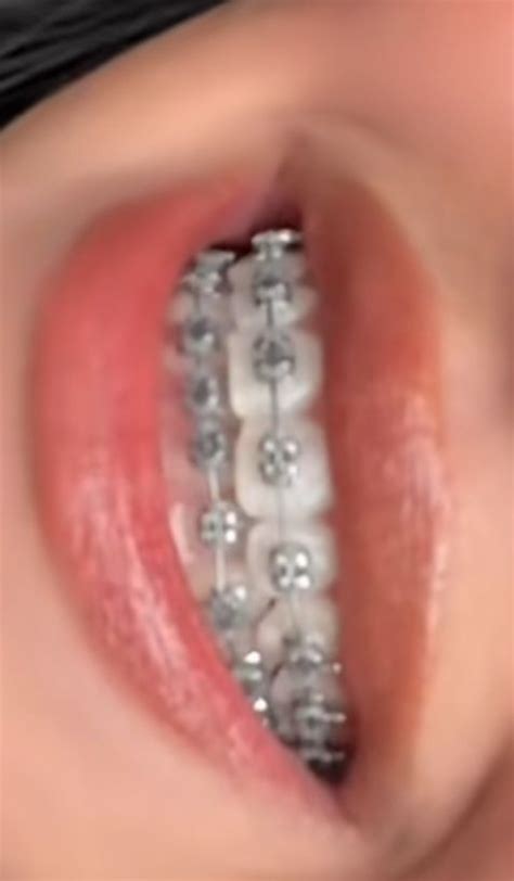 gray braces  stunning smile transformation light silver braces