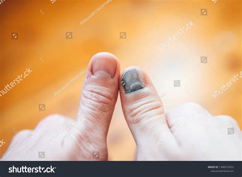 Man Hands Bruised Thumb Finger Subungual Stock Photo 1348210322 ...