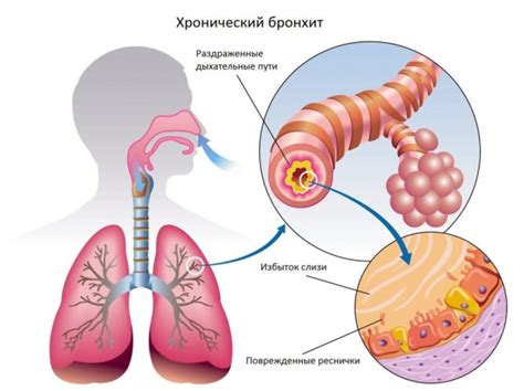 Хронический бронхит - симптомы и лечение у взрослых | Med & Care