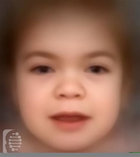 Hurler Syndrome