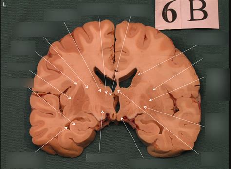 Anterior coronal section Diagram | Quizlet 