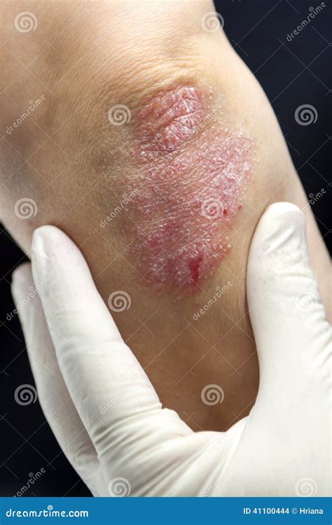 Psoriasis On Elbows Stock Photo | CartoonDealer.com #41100378