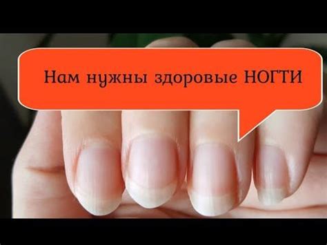 АСД 3 фракция ПРОТИВ Грибка ногтей. - YouTube | Здоровые ногти, Ногти ...