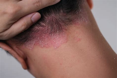 What Does Scalp Psoriasis Look Like? | Water's Edge