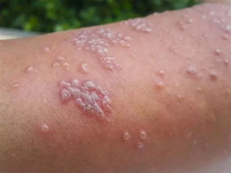 cacar air kembali marak jangan anggap remeh bunda