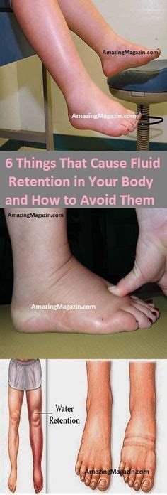 6 Things That Cause Fluid Retention in Your Body and How to Avoid Them ...