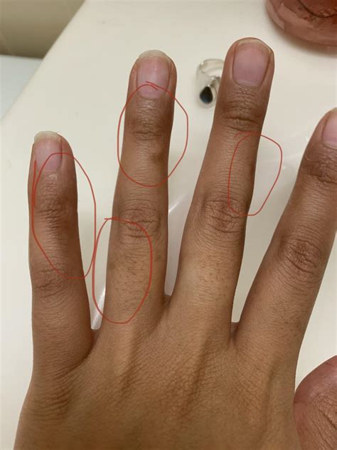 Dry Spots On Finger Joints at Celia Morgan blog