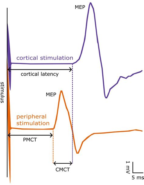 Absolute Refractory Period Ecg