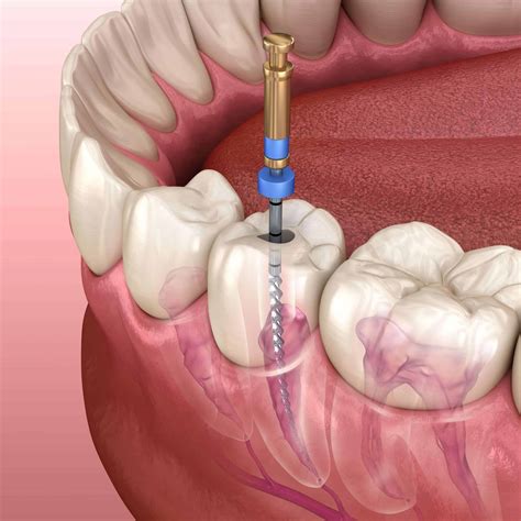 Root Canal Treatment in Culver City, CA | HD Dental Studios