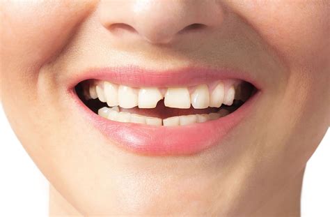 How to Fix a Chipped Tooth | Markham Dental Smiles
