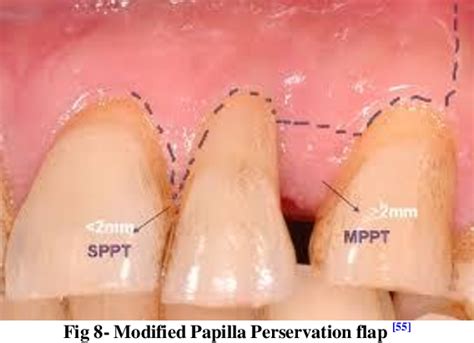 Figure 7 from Treatment of Interdental Papilla: A Review | Semantic Scholar