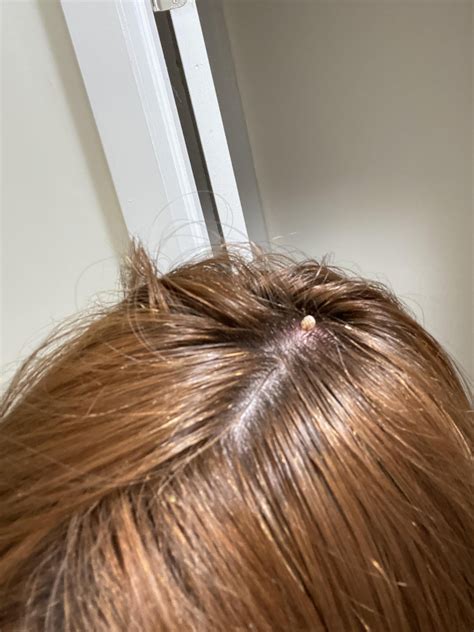 Pilar Cyst Popping out of scalp : r/popping