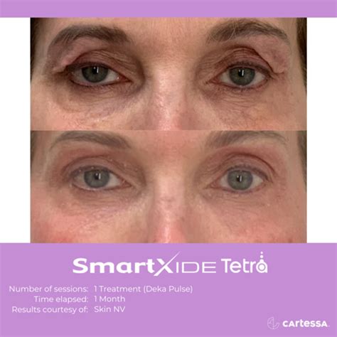 CoolPeel CO2 Laser Resurfacing Treatment in Jacksonville, Florida ...