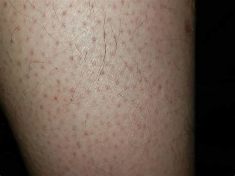 hair loss on legs 9