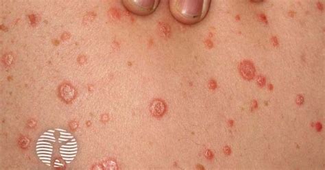 Guttate psoriasis image