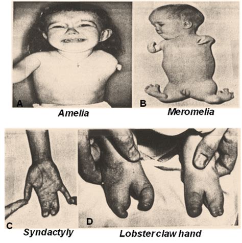 Limbs defects - DEVELOPMENT OF HUMAN SKELETAL SYSTEM