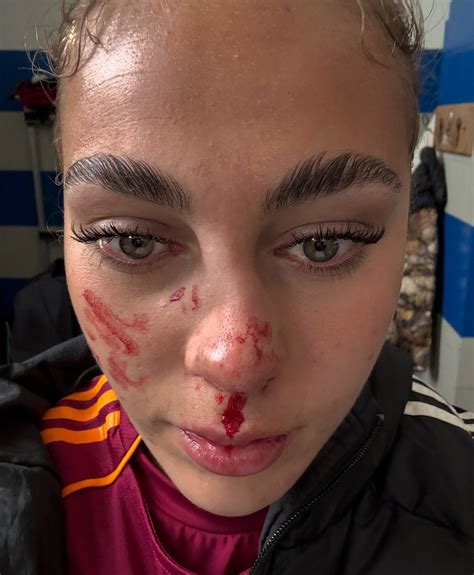 Alayah Pilgrim: Nasenbruch bei AS Roma-Spiel gegen Como