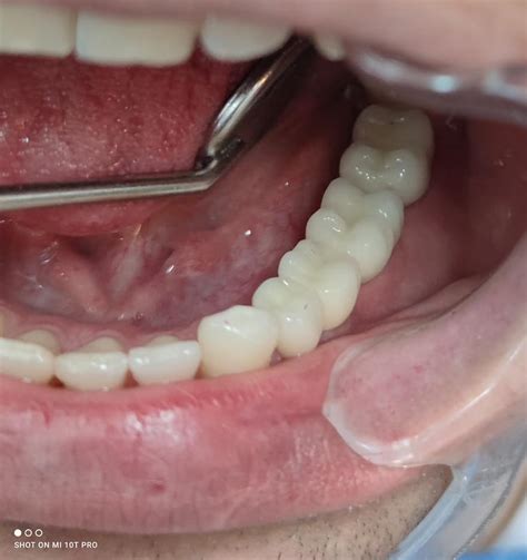 Implant dentar? Da, merită ! Pacientul din imagini a beneficiat de ...