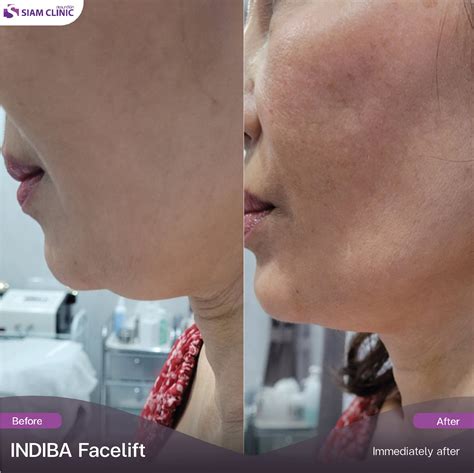 INDIBA Before and After Photos - Siam Clinic Thailand