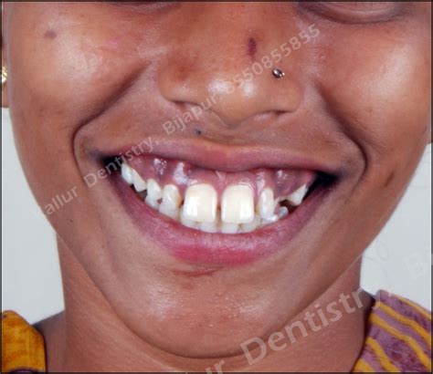 orthodontics crooked teeth kallur dentistry