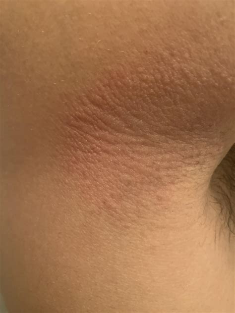 Identify? Rash behind armpit. No change in deodorant : r/medical_advice