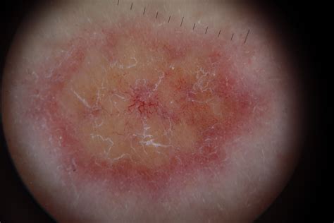 Derma-Docència Castelló: Necrobiosis lipoídica