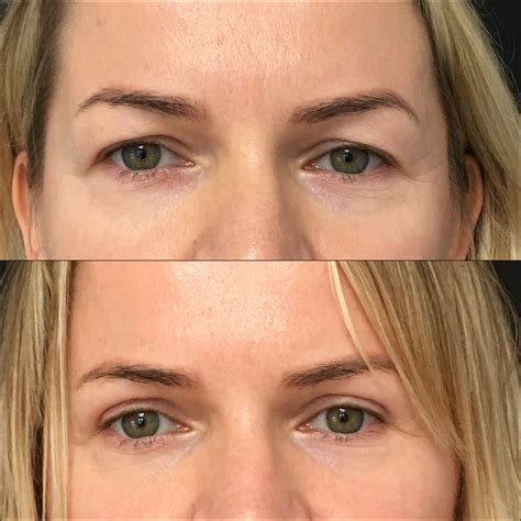 What Are Hooded Eyes? A Comprehensive Guide - Medrein Health and Aesthetics
